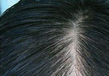 脂溢性脱发的出现和什么原因有关