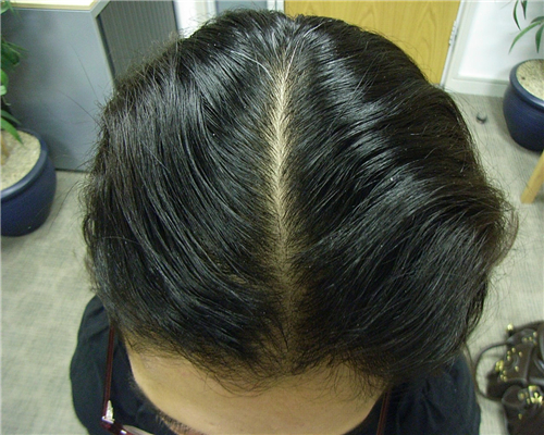 女性脱发的治疗方法