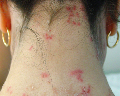 色素性痒疹会导致脱发吗