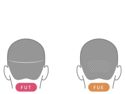 FUE和FUT植发技术之间有什么区别和关系吗