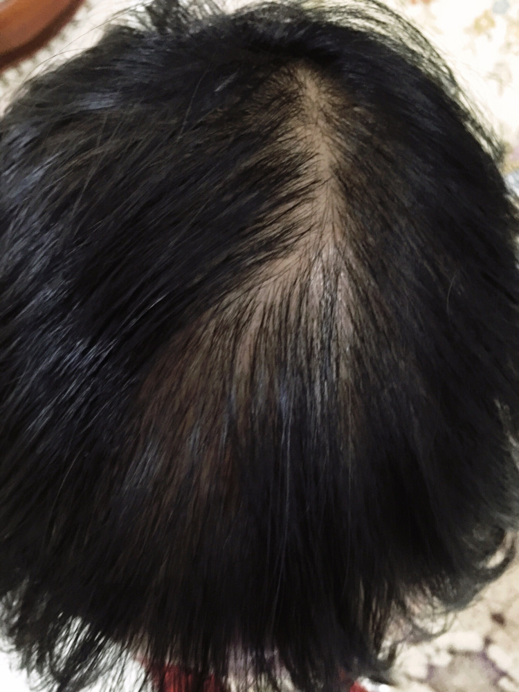 控油为什么不能缓解溢脂性脱发？