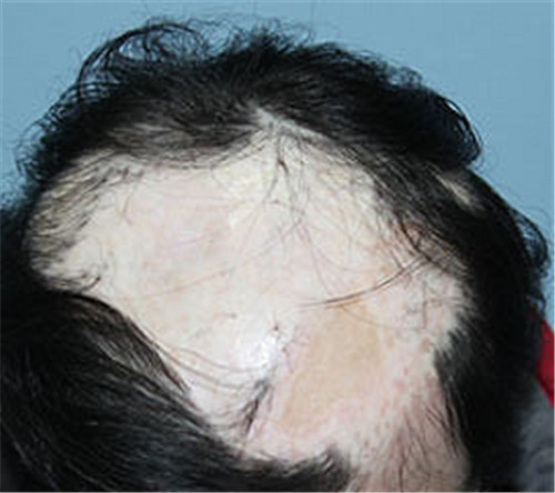 瘢痕性脱发是否能做植发手术？