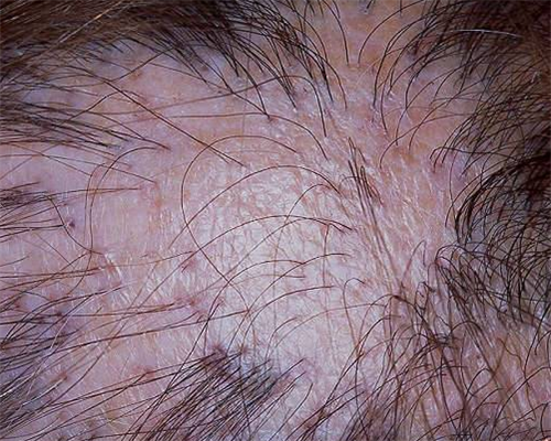 瘢痕性脱发是什么