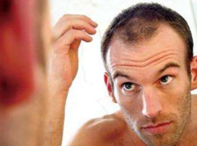 男性和女性植发之前有什么不同吗