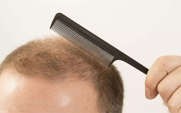 脂溢性脱发怎么根治？这下有了答案