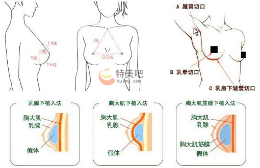 假体隆胸的切口和置入层次