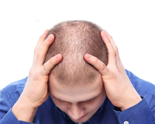 三个问题判断是否适合做头发治疗