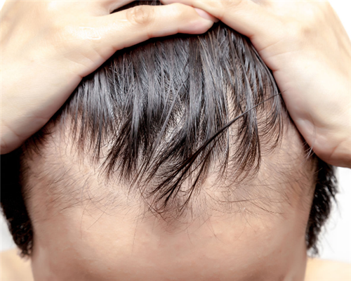 预防男性脱发的方法