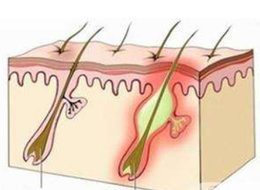 为什么会有毛囊炎，毛囊炎脱发该怎么办