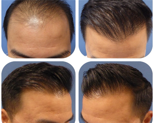 植发手术后脱发的预防方法