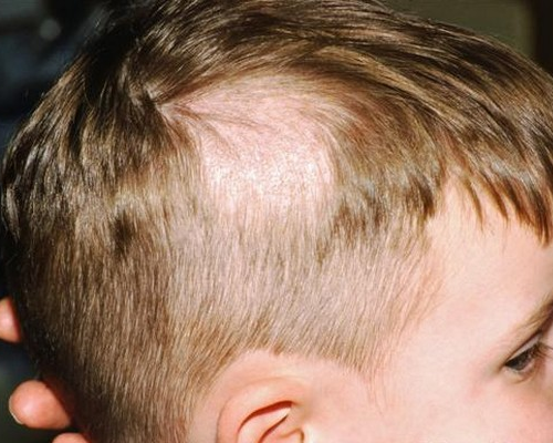 两种主要导致儿童脱发的问题