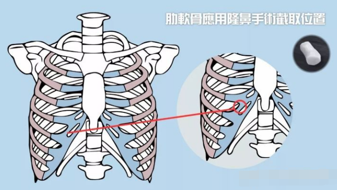 肋软骨隆鼻