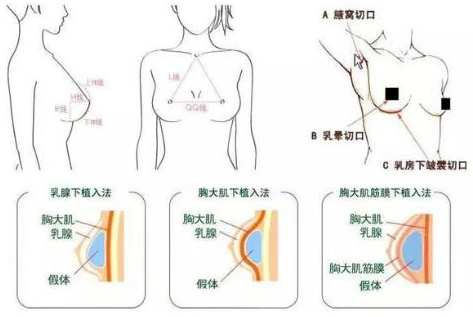 假体隆胸的过程: