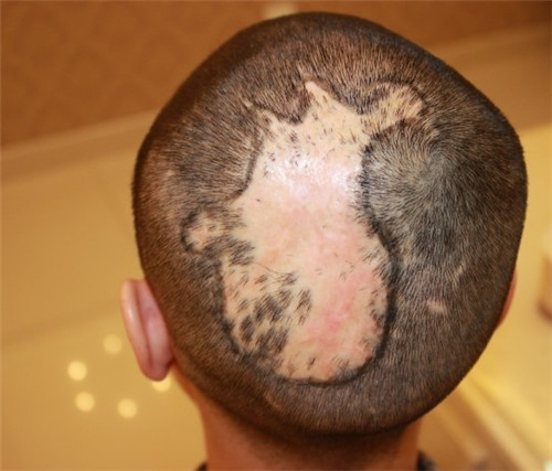 提问：植发手术能修复疤痕造成的脱发吗？