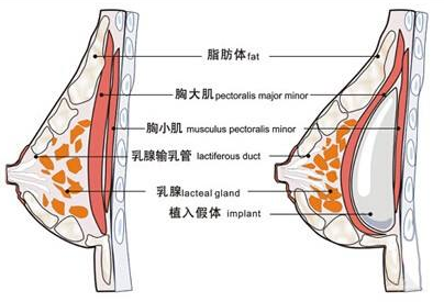 假体隆胸