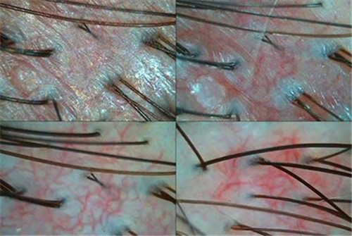 头皮上长痘痘是什么原因？需要注意什么？