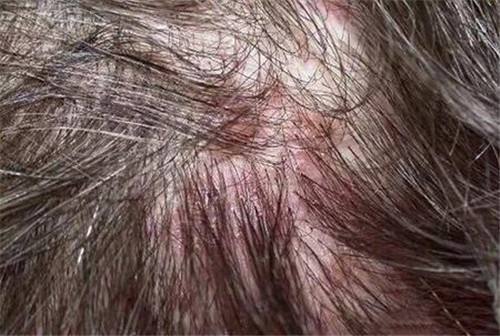 植发手术后出现了毛囊炎应该怎么办？