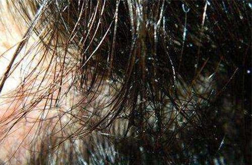 为什么脱发患者中都有头皮出油的情况？