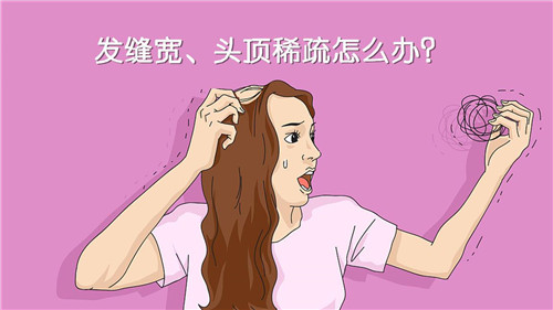 女性头顶脱发能不能恢复？