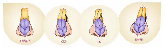歪鼻的种类