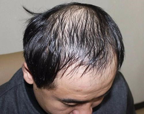 脂溢性脱发可以每天洗头吗？