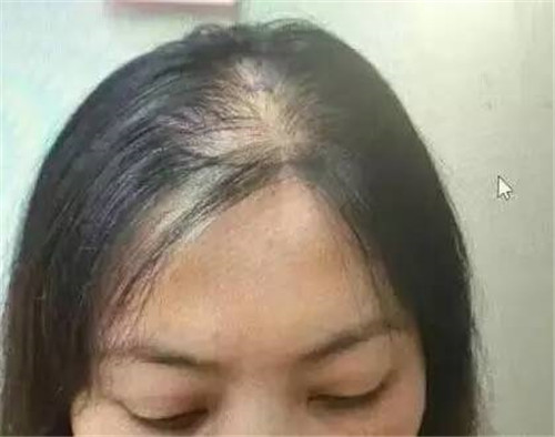 女性出现头顶脱发还能恢复吗？