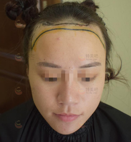南昌瑞丽诗植发医院种植发际线术后第2天种植发际线