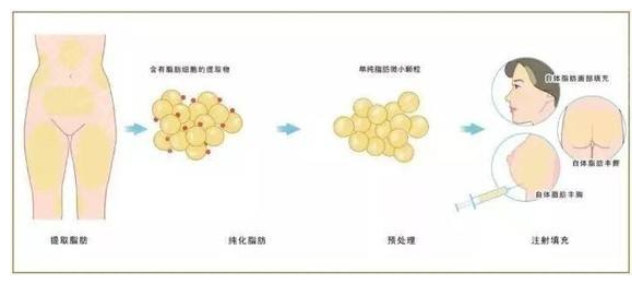 自体脂肪填充示意图