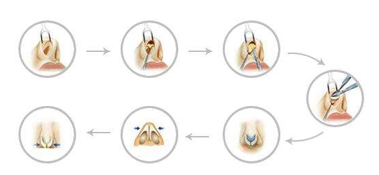 隆鼻手术过程