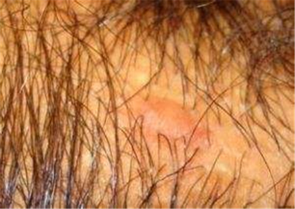 什么是毛囊炎？