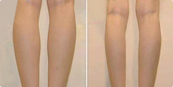 射频溶脂瘦小腿术前术后