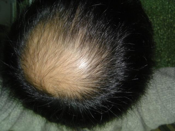 常规植发就是头皮已经光滑的脱发部位直接种植上头发;毛发加密就是