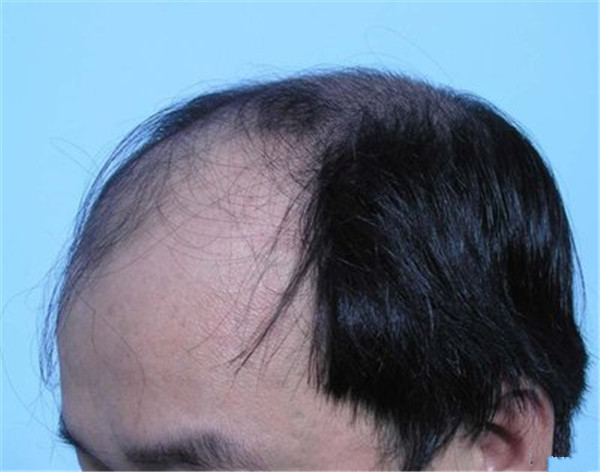 在什么情况下容易引起脂溢性脱发？