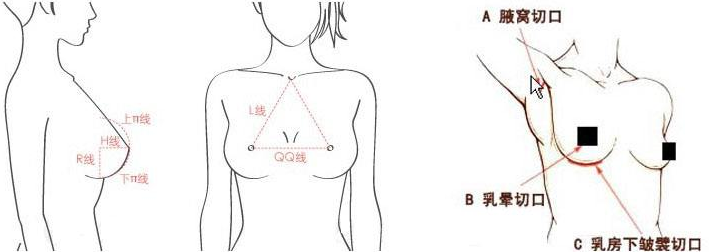 假体隆胸切口位置