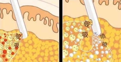 吸脂原理