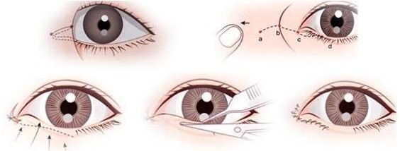 开内眼角手术过程