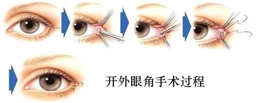 开外眼角