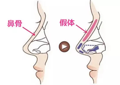 隆鼻假体