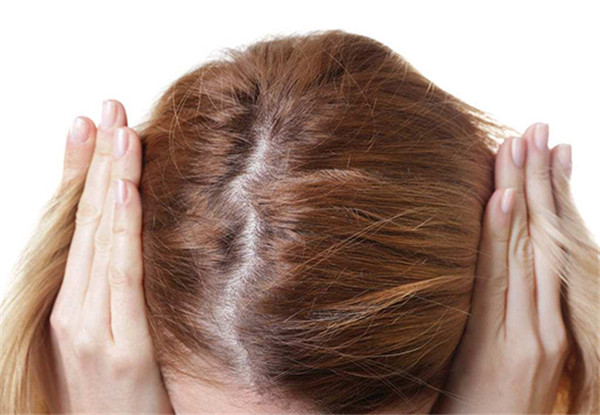 女性局部脱发的原因有哪些？