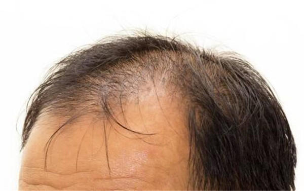 脂溢性脱发应该勤洗头还是少洗头？