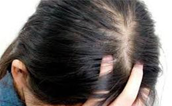 女性脂溢性脱发可以治愈吗？