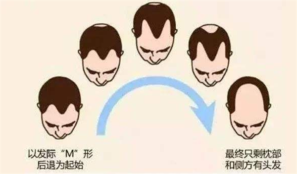 男性遗传性脱发主要表现在什么？