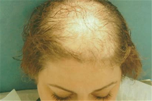 脂溢性脱发应该怎么去治疗？