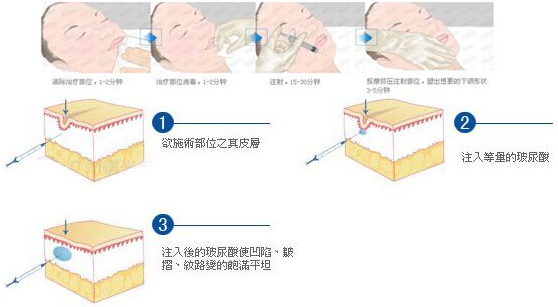 玻尿酸丰下巴