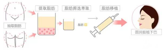 自体脂肪丰下巴