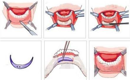 假体垫下巴