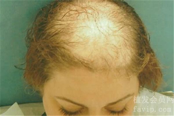 怎样才能分辨出是不是脂溢性脱发？