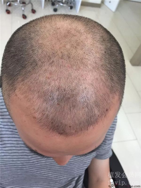 为什么头顶毛发加密种植，需要用到两种技术？