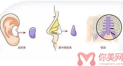 自体软骨隆鼻