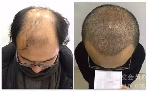 毛发移植后脱落期需要多久时间